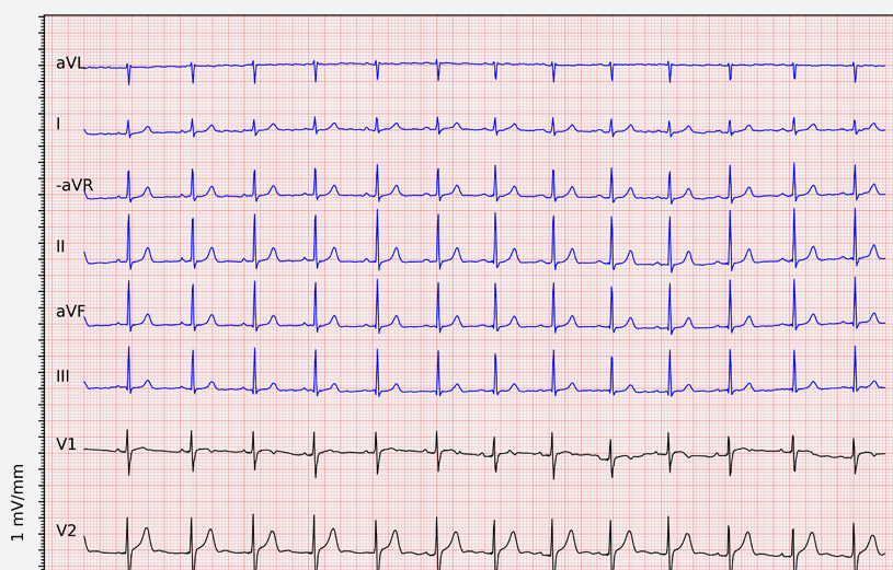 EKG strip